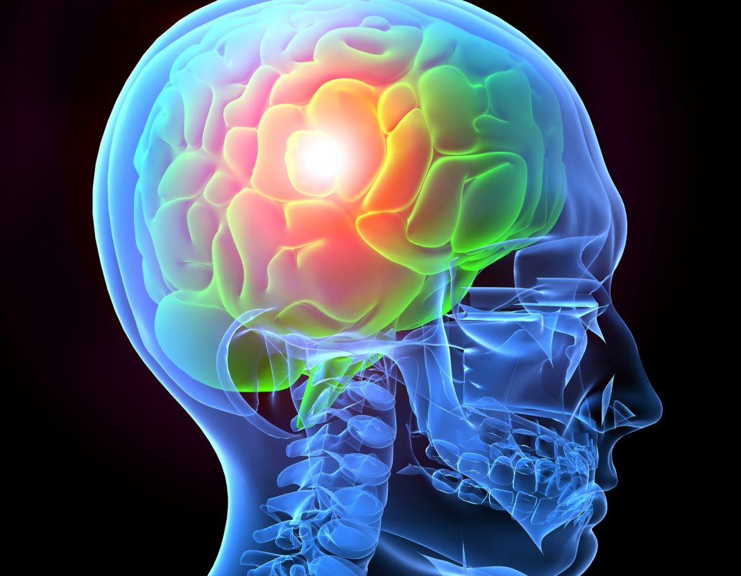 La oclusión de las arterias carótidas del cuello, los infartos y las embolias