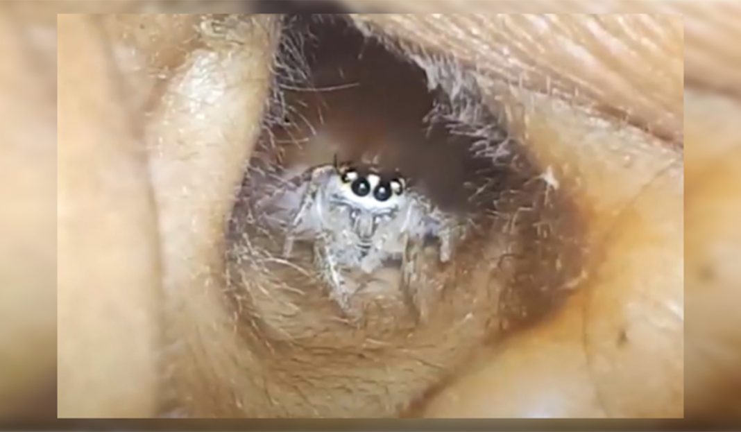 Doctor me duele la cabeza ¿qué tengo? Pues…¡Una araña! VIDEO DE TERROR