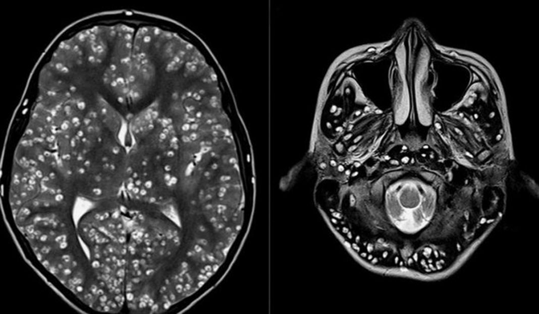 Joven acude al médico por dolor de cabeza; tenia larvas en el cerebro