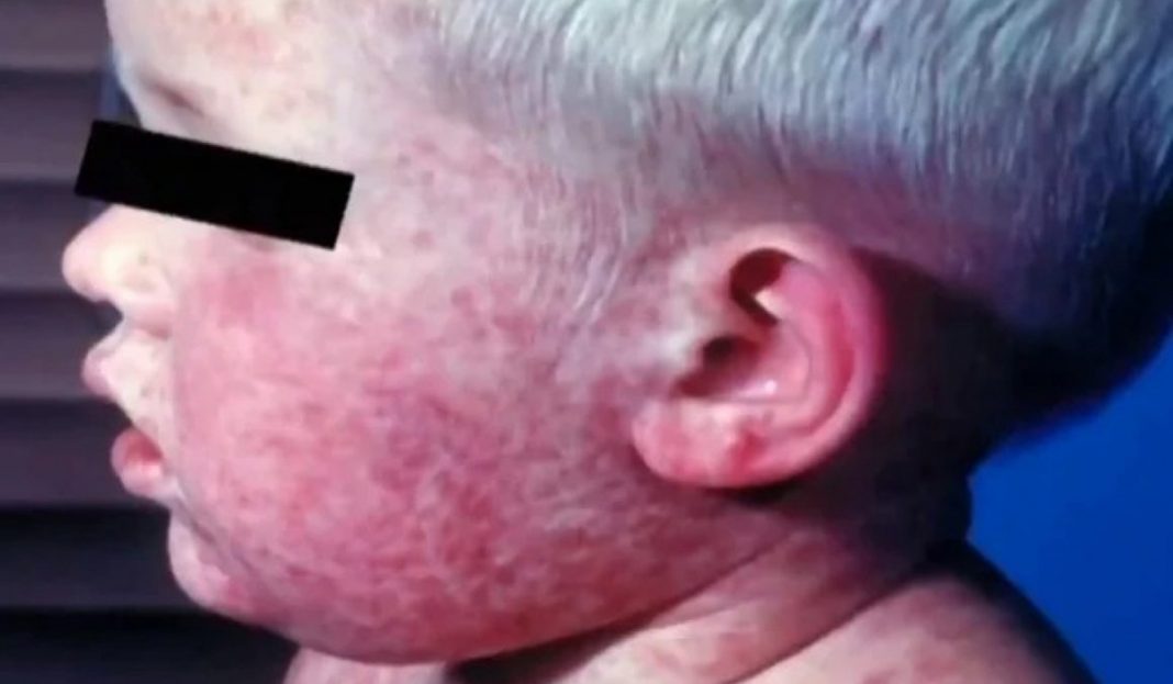 Este fue el niño que revivió el brote de sarampión en Estados Unidos