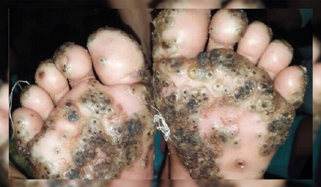 Niña juega descalza en charco y termina infectada por pulgas