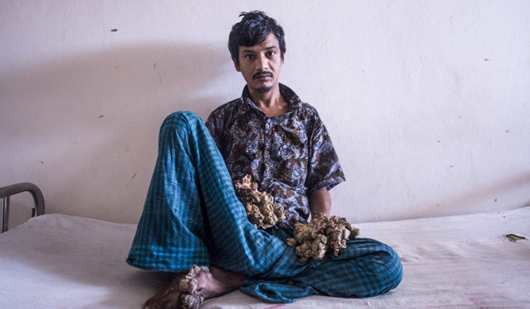 «No puedo soportar más el dolor»: El ‘hombre árbol’ de Bangladés pide que le amputen las manos