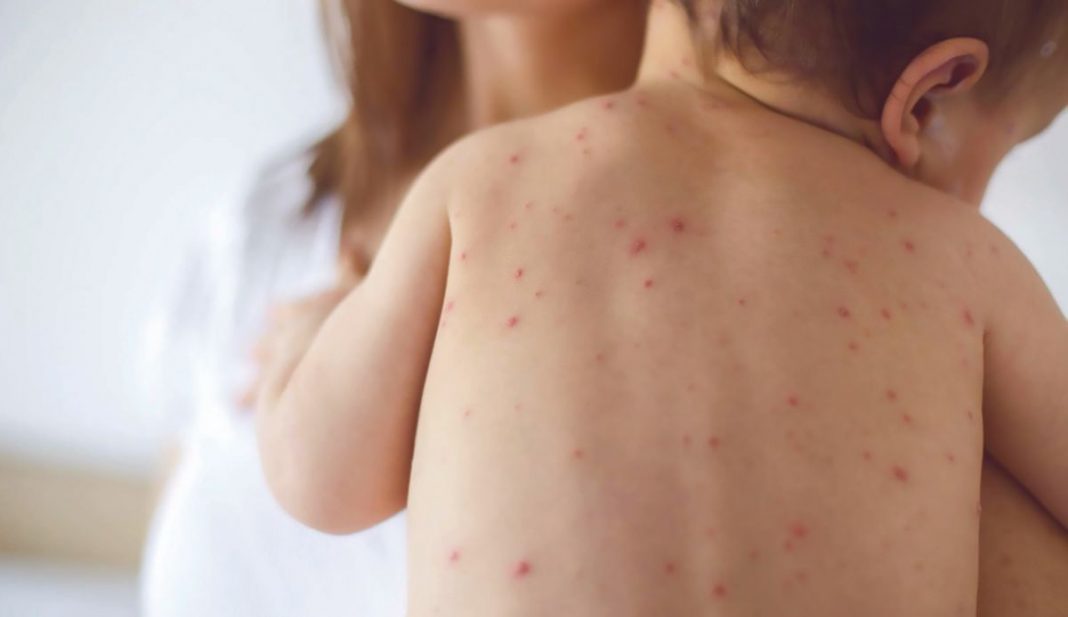 Se triplican los casos de sarampión en el mundo, según la OMS