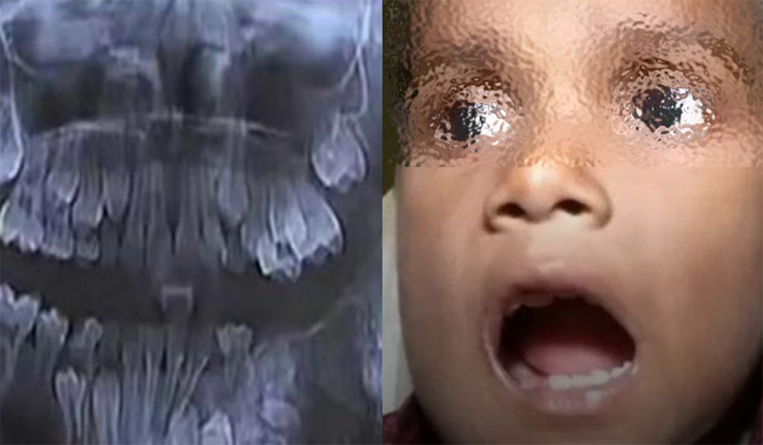 ¡WTF! Le extraen 526 dientes a un niño de 7 años
