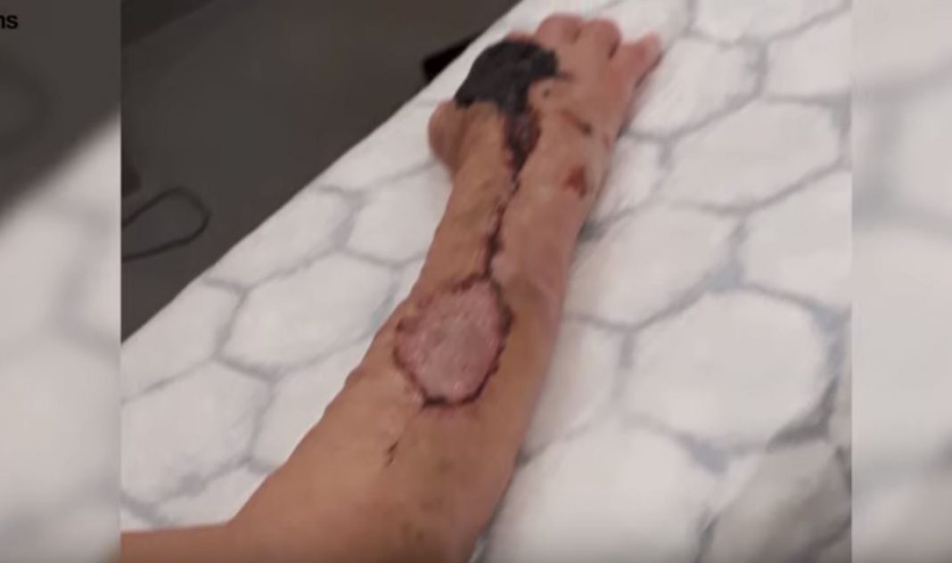 Mujer es inducida al coma en estado crítico por un rasguño de su gato