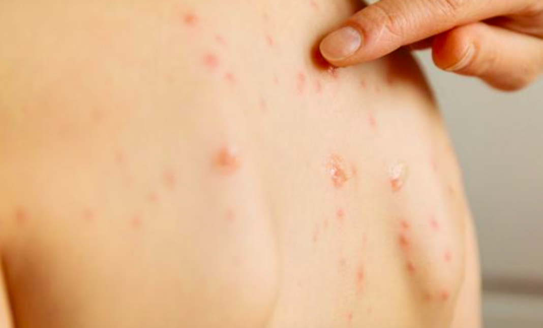 Alertan dispersión de sarampión, van más de 100 casos