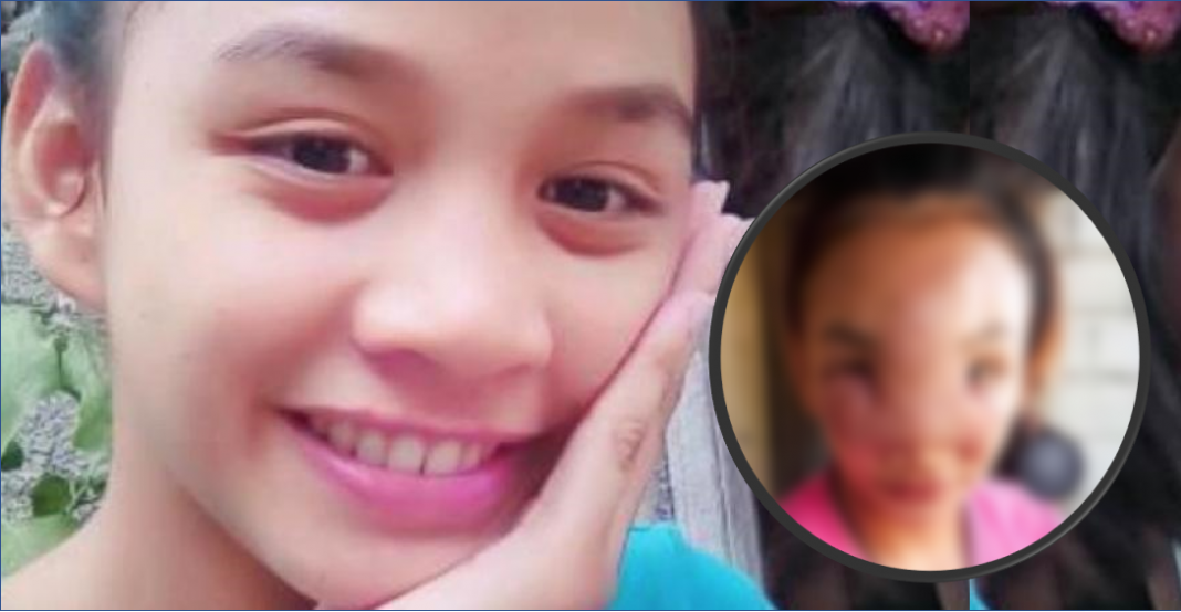 Se exprime espinilla e infección le desfigura el rostro