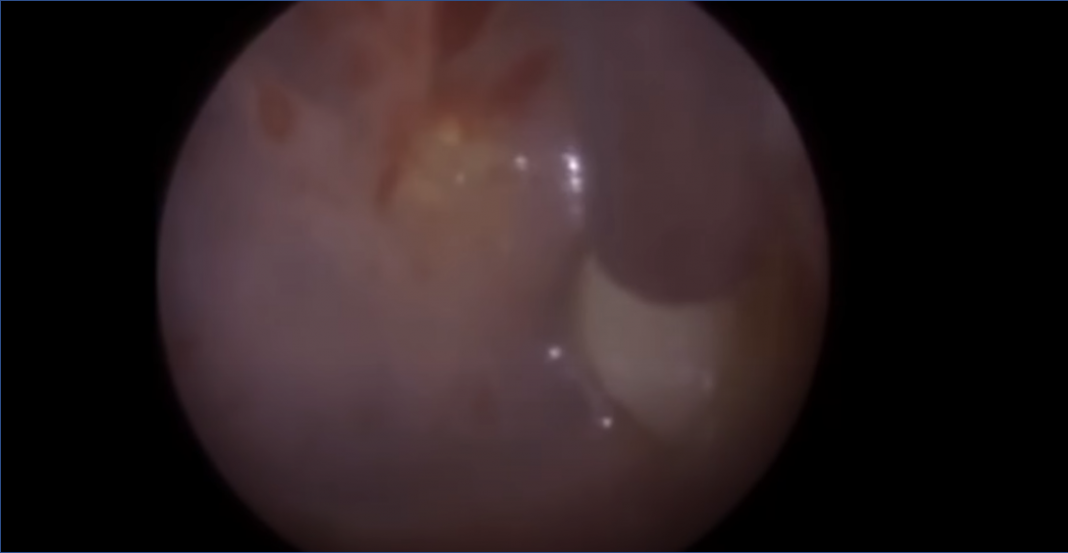 Dentista extrae diente del oído de un niño