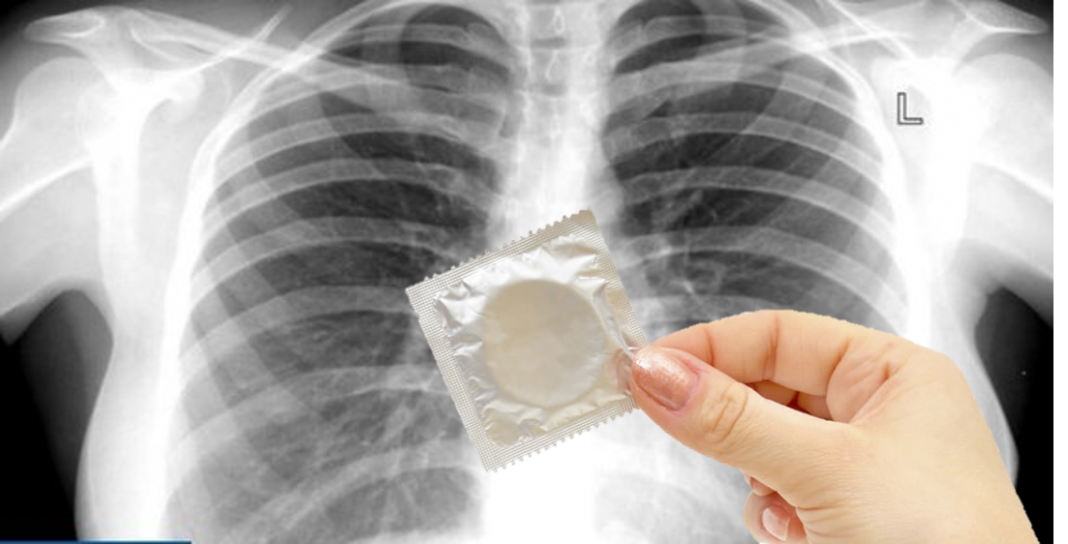 No era tuberculosis, ¡tenía un condón en sus pulmones!