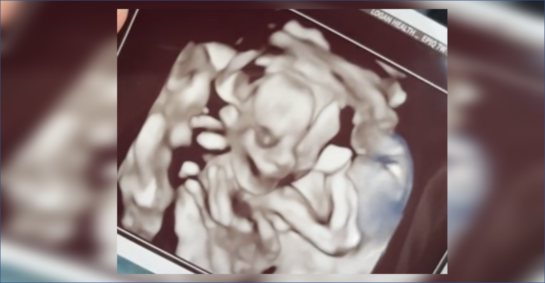 Papás muestran ‘terrorífico’ ultrasonido de su bebé