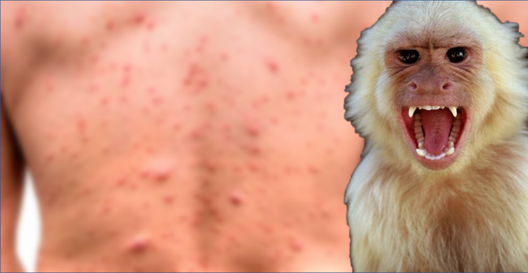 EU confirma primer caso de viruela del mono