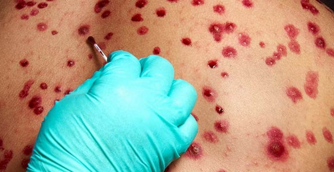 Positivo a viruela del mono, COVID-19 y VIH al mismo tiempo